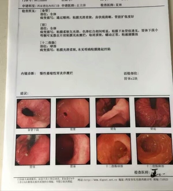 所以,当胃镜医生见到上述表现时,常常会胃镜诊断萎缩性胃炎.