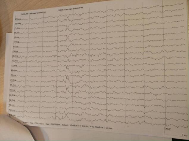 较长时间的脑电监测,可以帮助排除因偶发痫样放电而造成误诊的情况