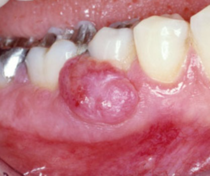 化脓性肉芽肿/血管性龈瘤 :上颌牙龈稍多于下颌牙龈,前部牙龈受累者