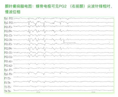 癫痫病各种脑电图波形解答