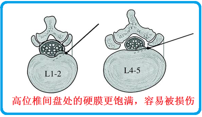 所以高位椎间盘病变手术,在脊髓圆锥部位进行操作, 是公认的脊柱外科_三利网 所以高位椎间盘病变手术,在脊髓圆锥部位进行操作, 是公认的脊柱外科