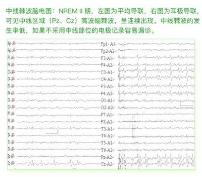 癫痫病各种脑电图波形解答