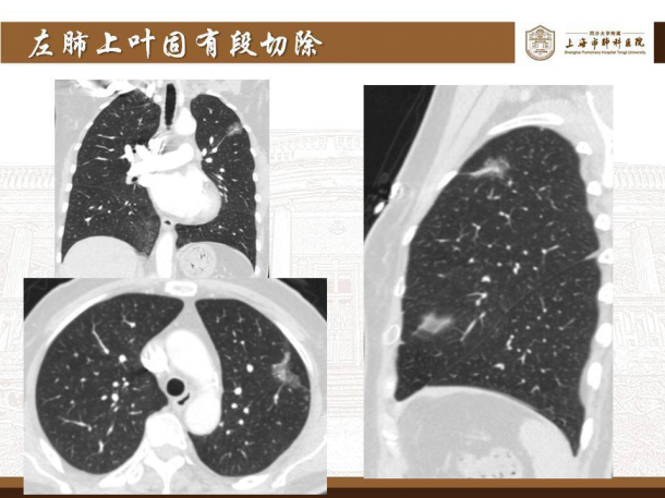 肺磨玻璃结节的微创手术——胸腔镜肺段切除