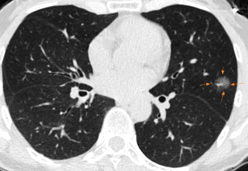 表现为肺磨玻璃结节/磨玻璃影(ggo/ggn)的典型肺癌