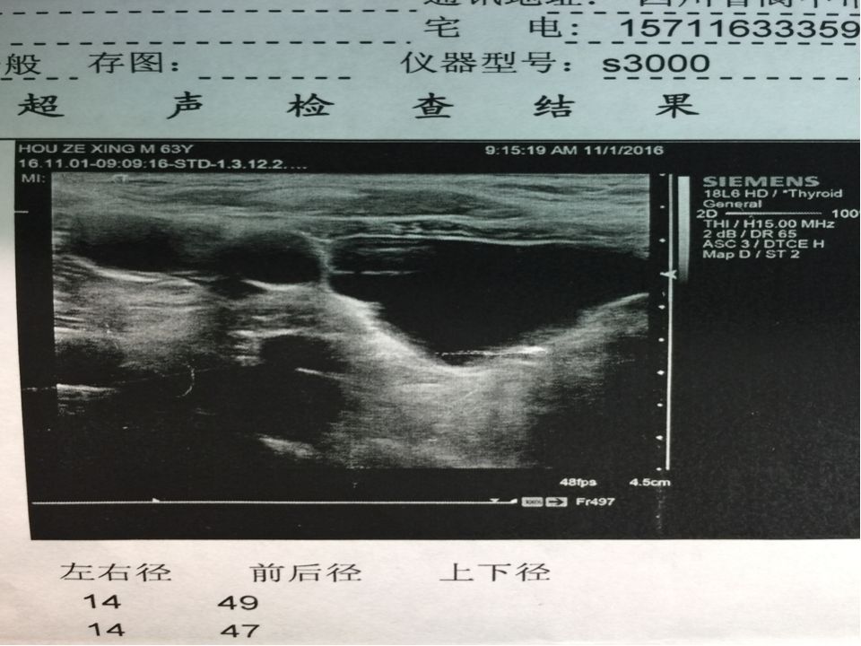 颈部少见囊性疾病甲状旁腺囊肿