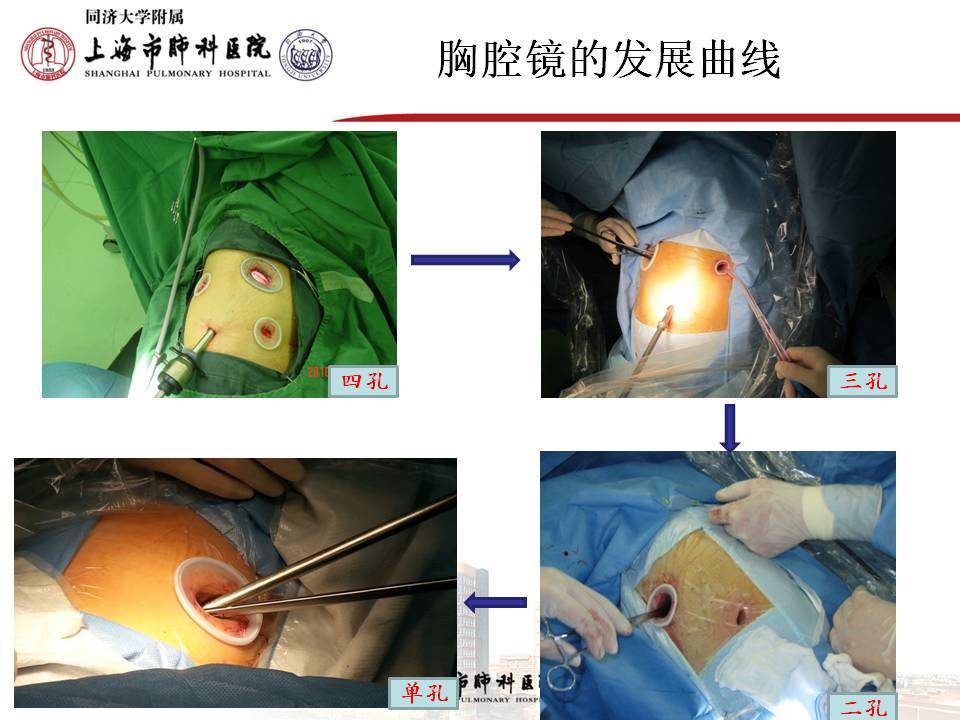 单孔胸腔镜手术 更微创,切口少 从四孔——三孔——双孔——单孔