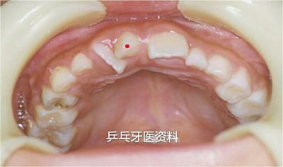 前牙区锥形多生牙