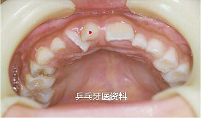 说说多生牙的那些事