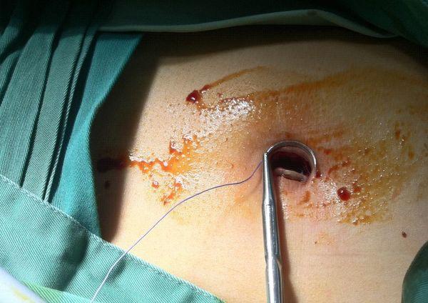 单孔双套管三器械腹腔镜胆囊切除术