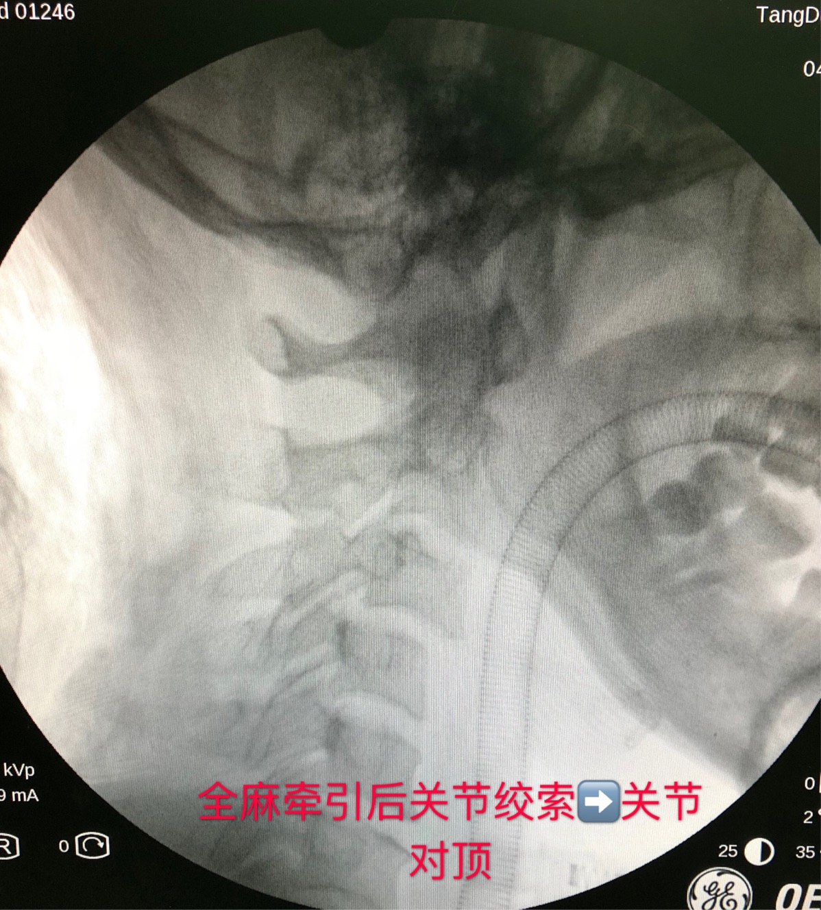 前路颈3椎体脱位关节绞索复位内固定术