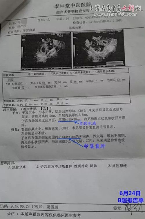 卵巢囊肿术后2次复发,中医百通疗法治疗2疗程,囊肿缩小95,盆腔积液