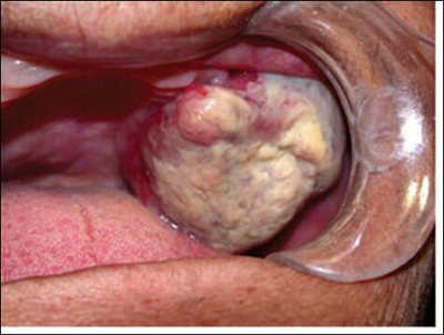 口腔癌之梭形细胞癌