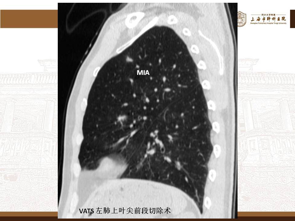 肺磨玻璃结节的微创手术——胸腔镜肺段切除