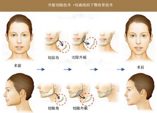 卢丙仑教授:下颌角手术方式方法手术过程详解