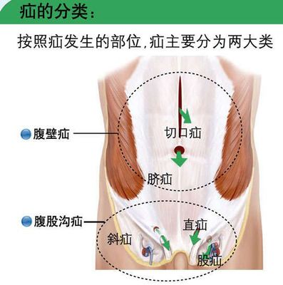 疝绝大多数发生在腹壁,是因为腹壁薄弱或缺损后腹腔内的小肠等脏器