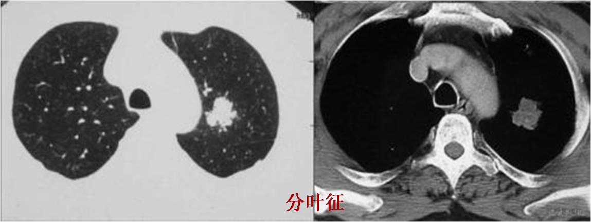 肺癌的七种典型ct影像学特征