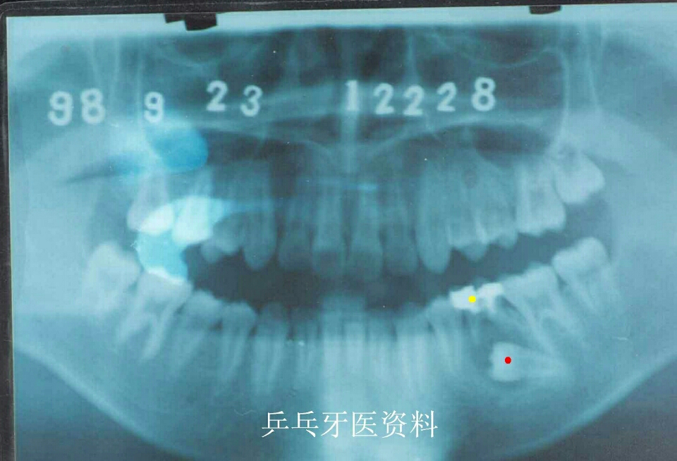 牙反复发炎对恒牙发育有影响吗