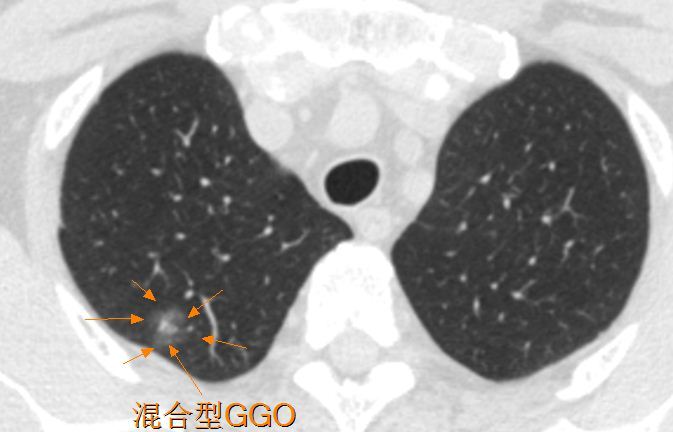 表现为肺磨玻璃结节/磨玻璃影(ggo/ggn)的典型肺癌