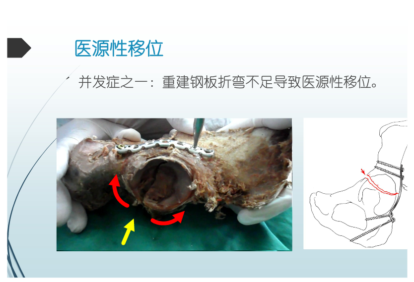 髋臼骨折的治疗