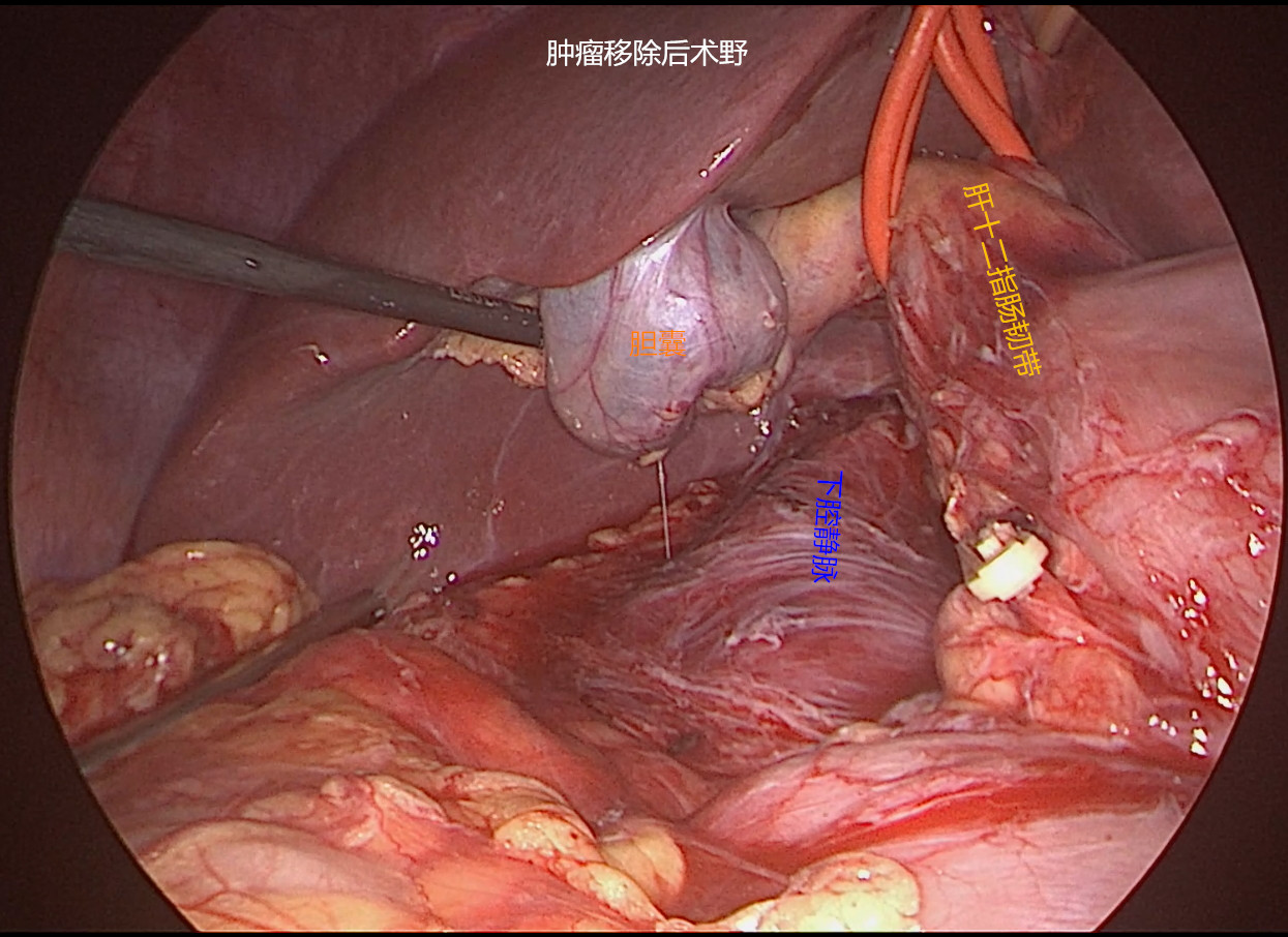 腹腔镜特殊部位后腹膜肿瘤切除术