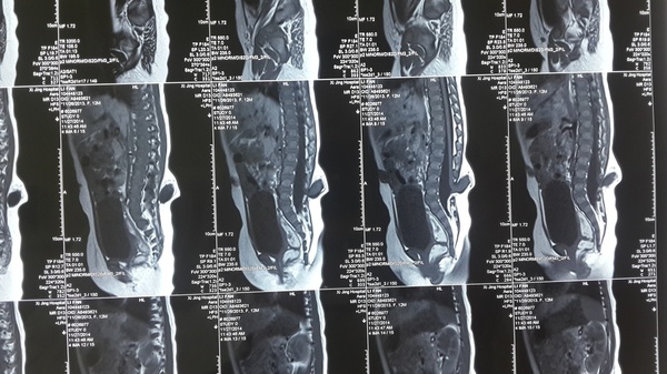 脊膜膨出囊婴儿(伴脊髓栓系):图1