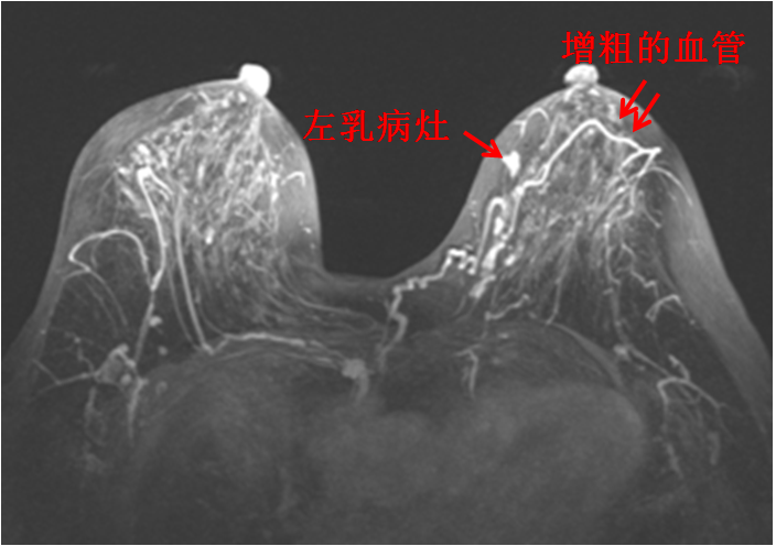 关于乳腺磁共振的那点事儿