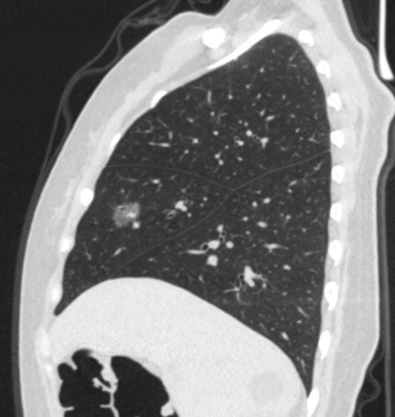 磨玻璃结节早期肺癌的典型特征