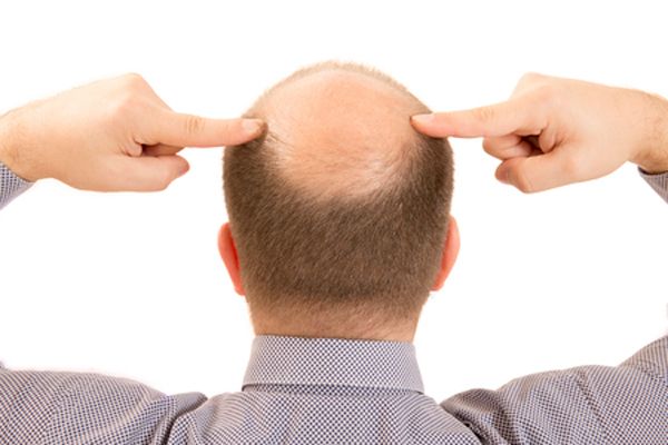 男性型脱发的病因是什么?