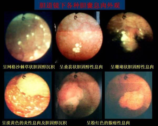 腹腔镜胆道镜联合微创保胆息肉摘除术的临床应用