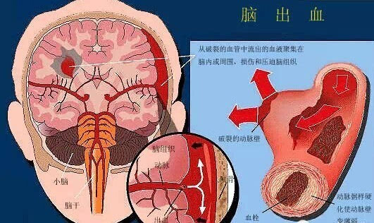 脑出血患者的康复治疗