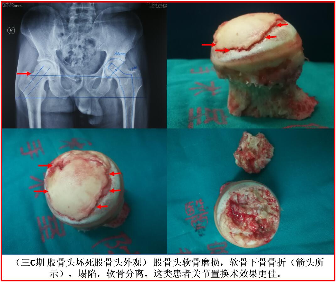 股骨头坏死的外形分期