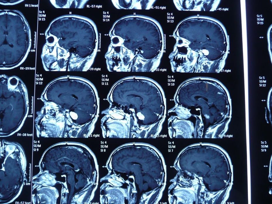 例1术前增强mri(矢位):右侧桥小脑角听神经瘤