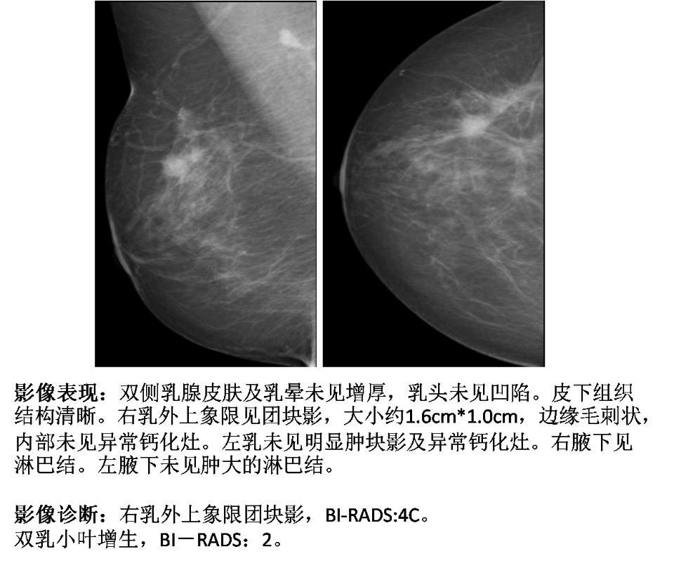 如何读懂乳腺钼靶报告