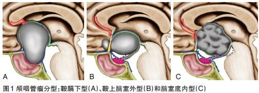 颅咽管瘤——最常见的先天性颅内肿瘤