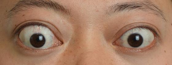 甲亢突眼为何要进行眼眶减压手术?