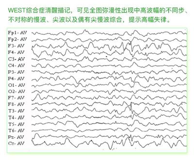 癫痫病各种脑电图波形解答