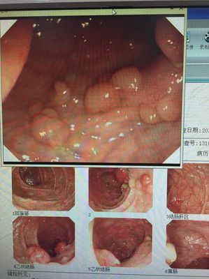 结肠息肉严重吗 www.guahao.com