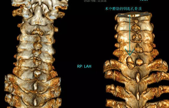 手痛竟是颈椎神经受压"惹的祸"