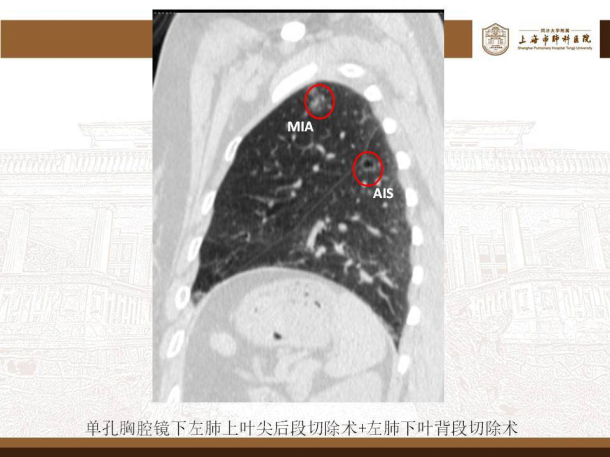 肺磨玻璃结节的微创手术——胸腔镜肺段切除