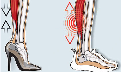 除了崴脚之外,穿高跟鞋时小腿肌肉长时间紧绷,拉紧跟腱,如果经常长