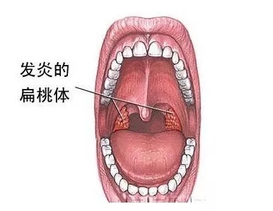 小孩扁桃体到底切还是不切?