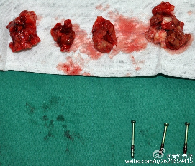 第一次手术果然不出所料,手术当中发现关节腔里有大量脓液和肉芽组织