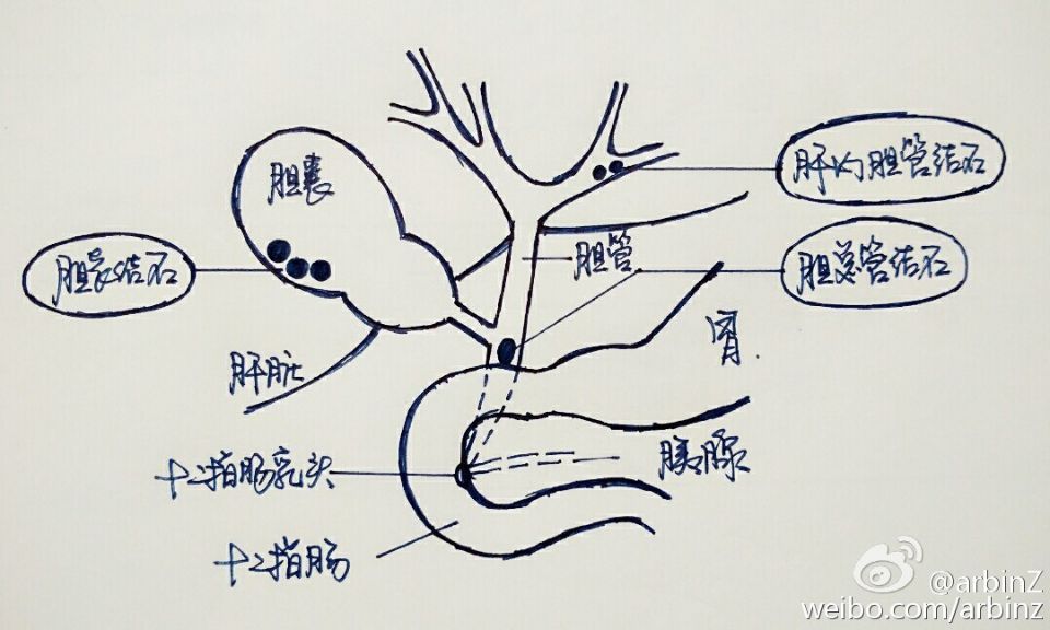 6. 胆管结石和胆囊结石有什么区别?