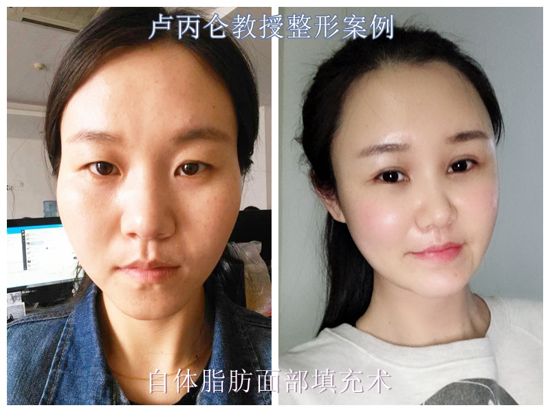 "苦命脸"的出现原因及治疗