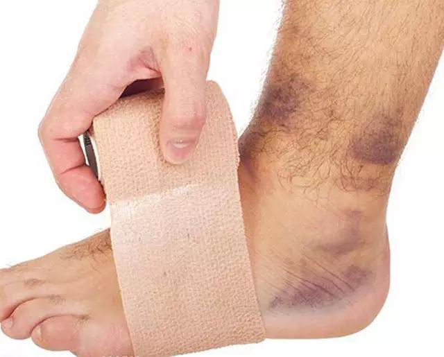 严重的踝关节扭伤需要用支具保护 慢性期