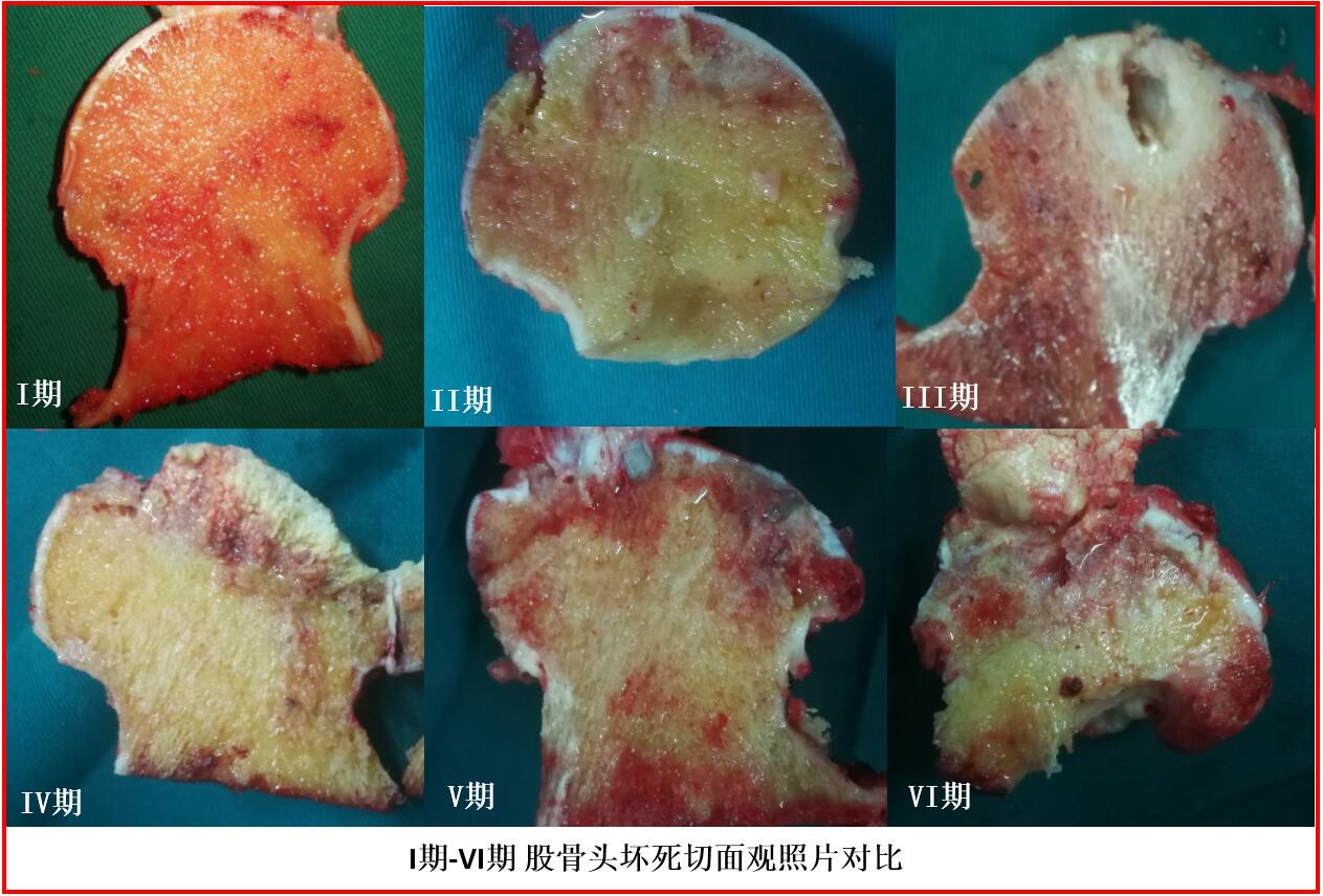 老百姓流传一句话:股骨头坏死是不死人的骨癌,可见这种疾病给患者带来