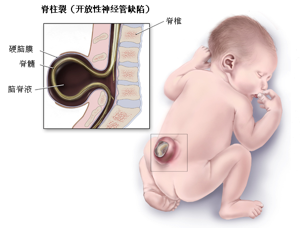 显性脊柱裂患儿出生时背部有局部包块,单纯脊膜膨出可以无明显症状