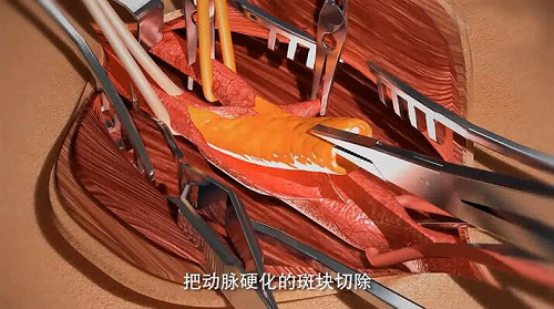 颈动脉内膜剥脱术示意图