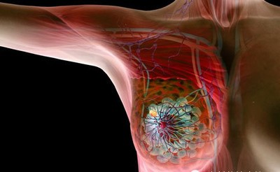 炎性乳腺癌是一种罕见,增长迅速的肿瘤,通常没有明显包块,但是局部
