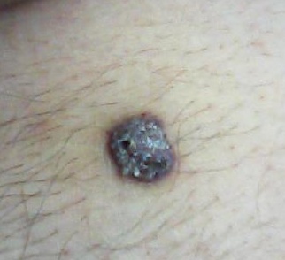 黑痣应该怎样治疗?如何辨别良性恶性?